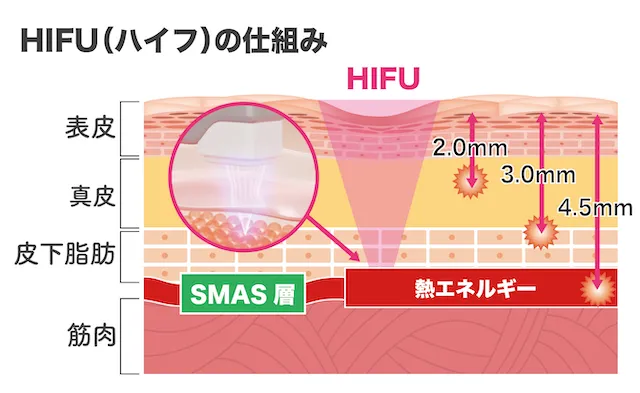 HIFUの仕組み