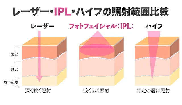 IPL_レーザー_ハイフ比較