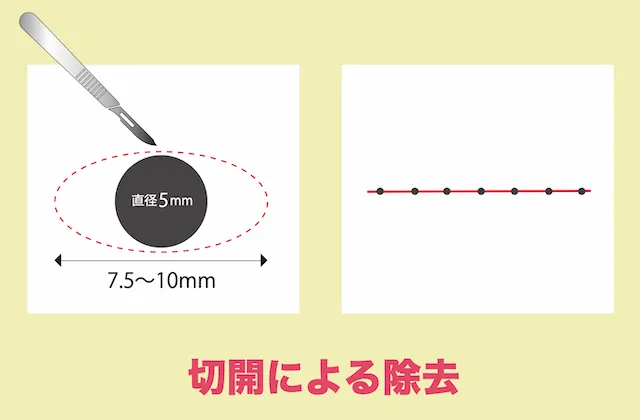 切開　ほくろ