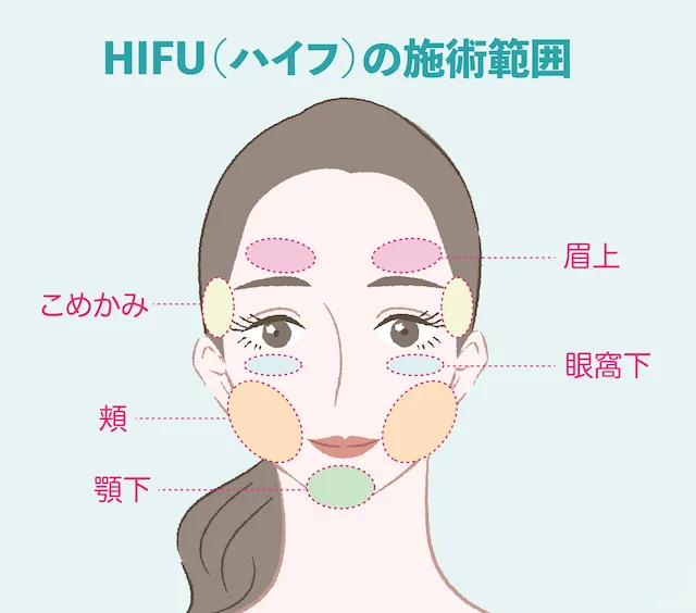 HIFUの施術範囲