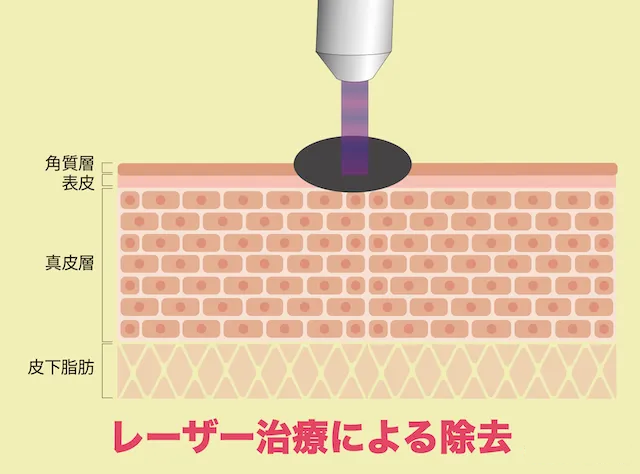 レーザー治療による除去